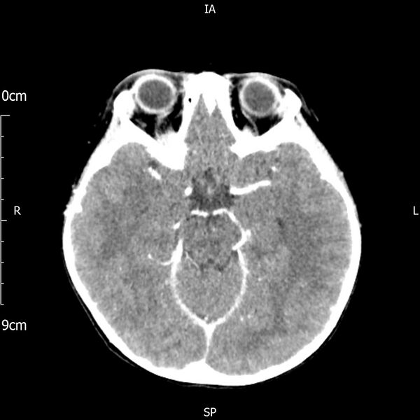File:Cavernous sinus thrombosis (Radiopaedia 79414-92510 Axial Brain 88).jpg