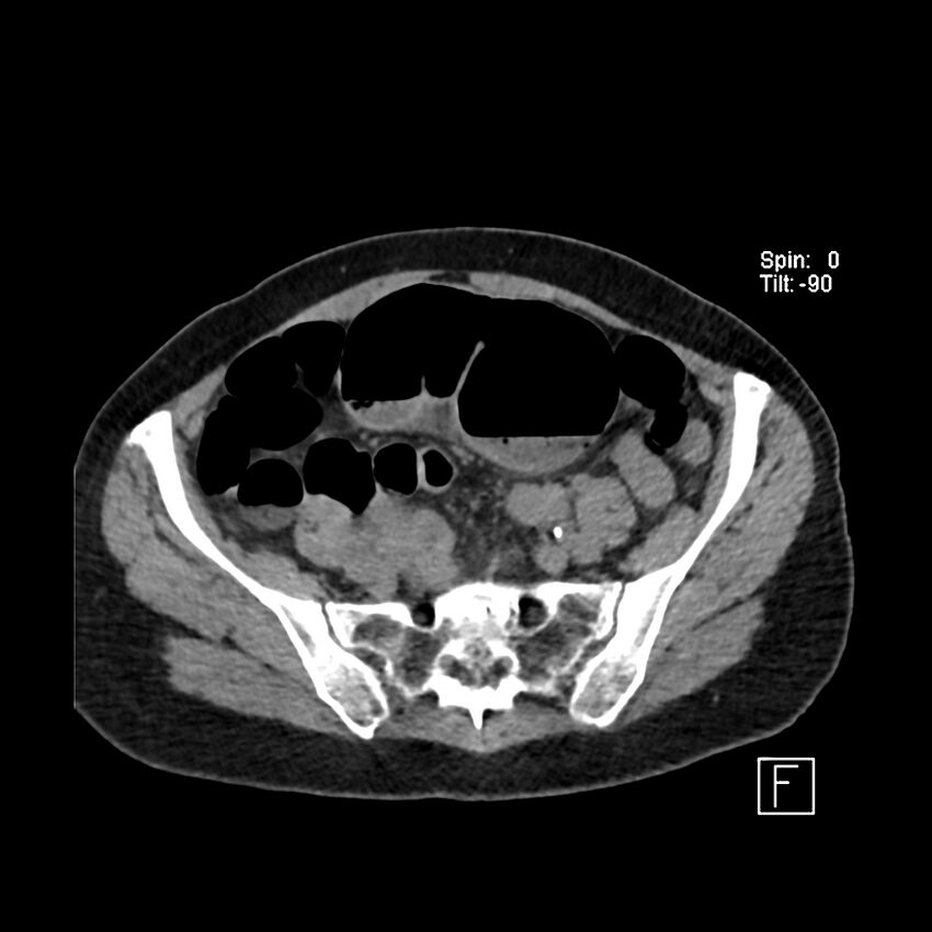 Cecal volvulus (Radiopaedia 90897-108397 Axial non-contrast 48).jpg