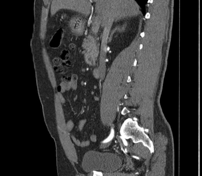 File:Celiac artery dissection (Radiopaedia 52194-58080 B 12).jpg