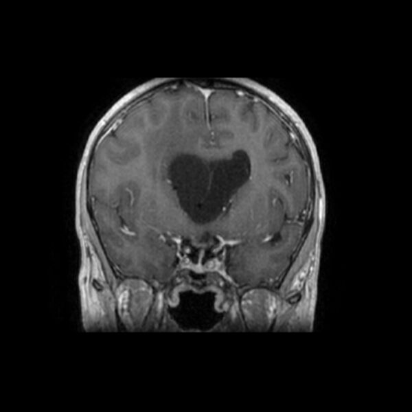 File:Central neurocytoma (Radiopaedia 67618-77021 Coronal T1 C+ 19).jpg