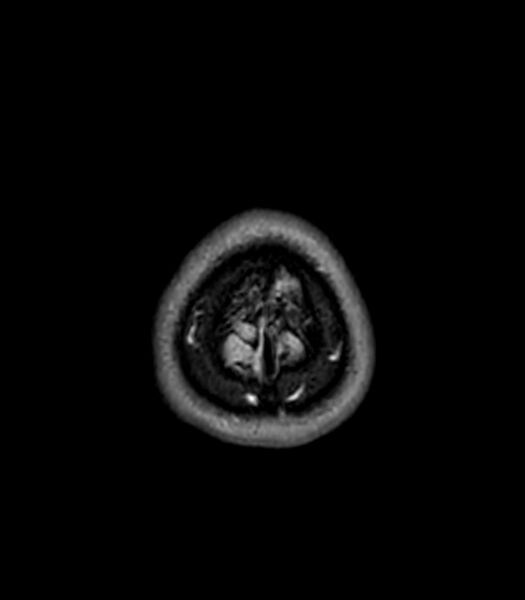 File:Central neurocytoma (Radiopaedia 79320-92380 Axial FLAIR 33).jpg