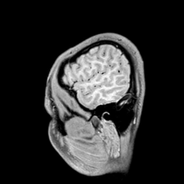 File:Central neurocytoma (Radiopaedia 79320-92380 Sagittal T1 39).jpg