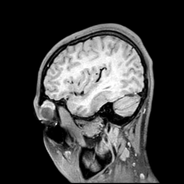 File:Central neurocytoma (Radiopaedia 79320-92380 Sagittal T1 64).jpg