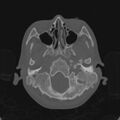 Cerebellar abscess secondary to mastoiditis (Radiopaedia 26284-26413 Axial bone window 27).jpg