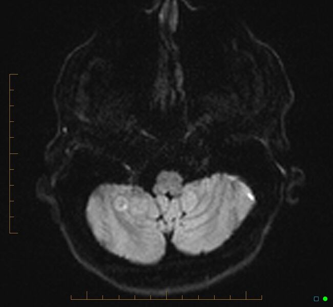 File:Cerebellar gangliocytoma (Radiopaedia 65377-74422 Axial DWI 6).jpg
