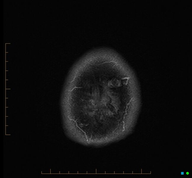 File:Cerebellar gangliocytoma (Radiopaedia 65377-74422 Axial FLAIR 39).jpg