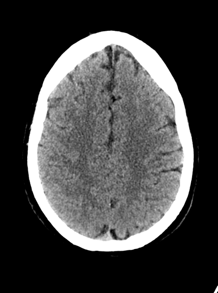 File:Cerebellar infarct due to vertebral artery dissection with posterior fossa decompression (Radiopaedia 82779-97032 Axial non-contrast 22).png