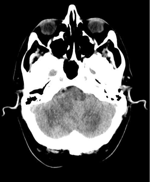 File:Cerebellar metastasis from lung adenocarcinoma (Radiopaedia 86690-102828 Axial non-contrast 6).png