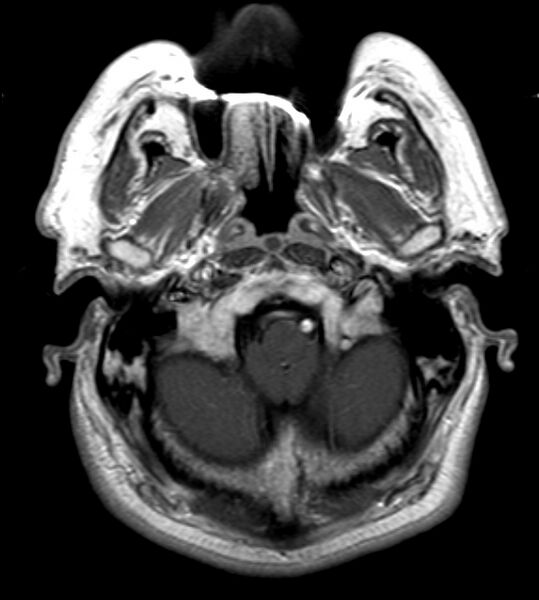 File:Cerebellopontine angle meningioma (Radiopaedia 24459-24764 Axial T1 C+ 3).jpg