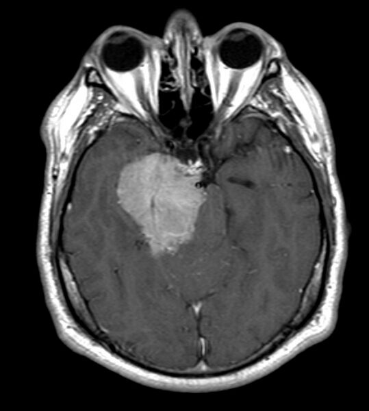 File:Cerebellopontine angle meningioma (Radiopaedia 24459-24764 Axial T1 C+ 9).jpg