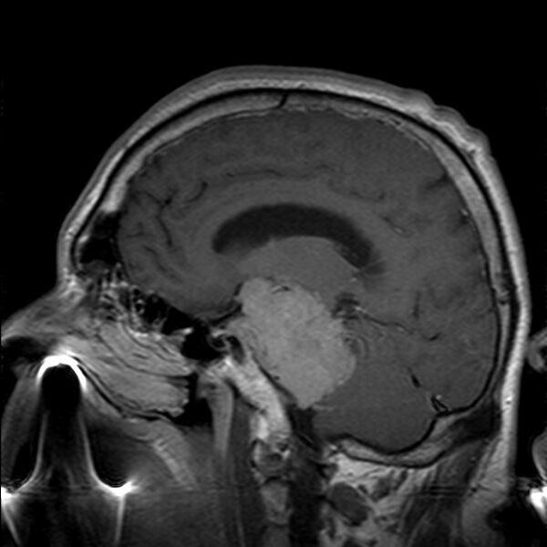 File:Cerebellopontine angle meningioma (Radiopaedia 24459-24764 Sagittal T1 C+ 11).jpg