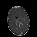 Cerebral abscess post cardiac surgery (Radiopaedia 27244-27420 Axial T1 C+ 13).jpg