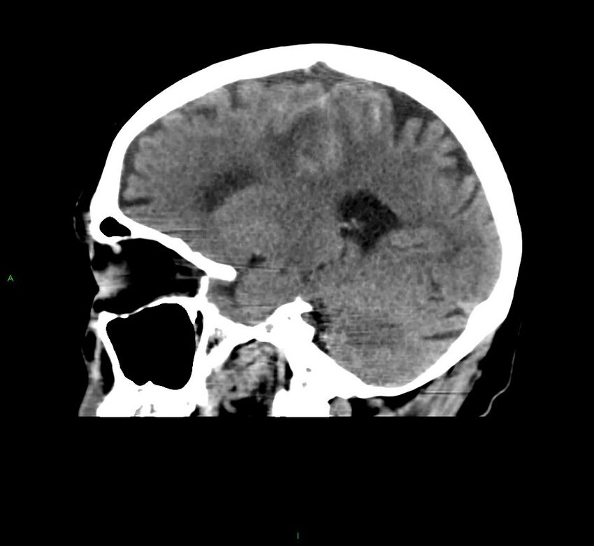 Cerebral amyloid angiopathy-associated lobar intracerebral hemorrhage (Radiopaedia 58376-65511 C 34).jpg