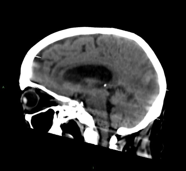 File:Cerebral amyloid angiopathy-associated lobar intracerebral hemorrhage (Radiopaedia 58377-65514 B 24).jpg