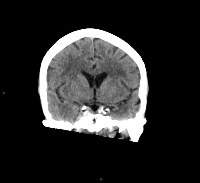 File:Cerebral amyloid angiopathy-associated lobar intracerebral hemorrhage (Radiopaedia 58378-65516 Coronal non-contrast 39).jpg