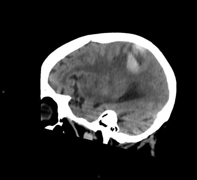 File:Cerebral amyloid angiopathy-associated lobar intracerebral hemorrhage (Radiopaedia 58530-65688 C 40).jpg