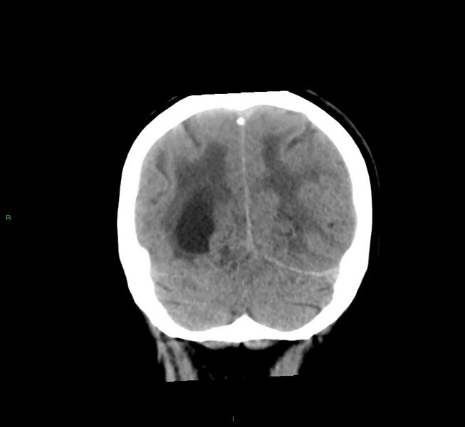 File:Cerebral amyloid angiopathy-associated lobar intracerebral hemorrhage (Radiopaedia 58561-65724 Coronal non-contrast 17).jpg