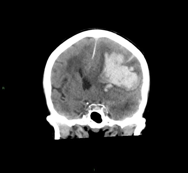 File:Cerebral amyloid angiopathy-associated lobar intracerebral hemorrhage (Radiopaedia 58561-65724 Coronal non-contrast 37).jpg