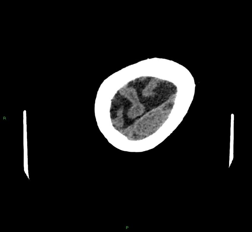 Cerebral amyloid angiopathy-associated lobar intracerebral hemorrhage (Radiopaedia 58757-65979 Axial non-contrast 132).jpg