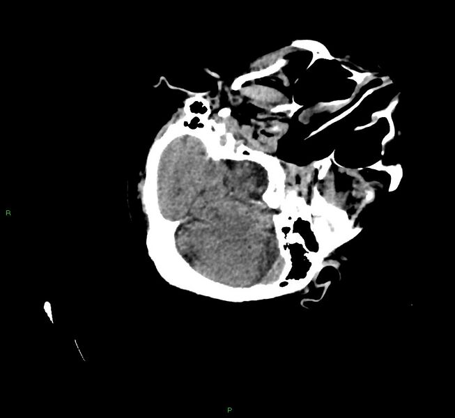 File:Cerebral amyloid angiopathy-associated lobar intracerebral hemorrhage (Radiopaedia 58757-65979 Axial non-contrast 33).jpg