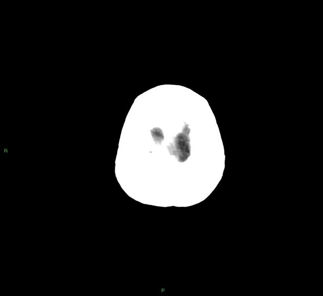 File:Cerebral amyloid angiopathy-associated lobar intracerebral hemorrhage (Radiopaedia 58758-65980 Axial non-contrast 4).jpg