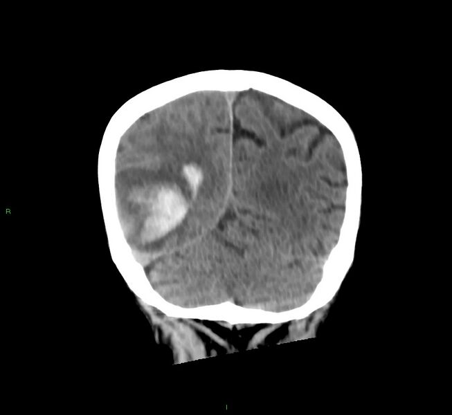 File:Cerebral amyloid angiopathy-associated lobar intracerebral hemorrhage (Radiopaedia 58758-65980 Coronal non-contrast 19).jpg