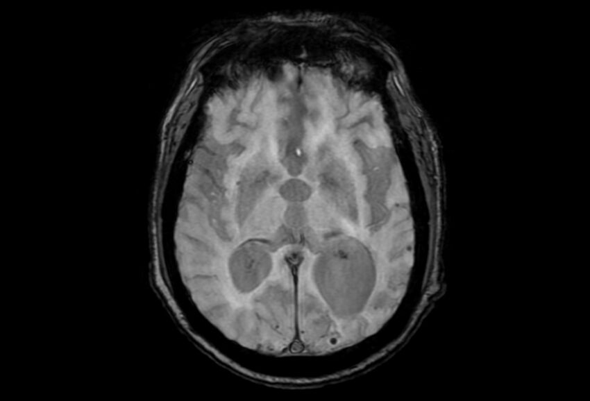 Cerebral amyloid angiopathy (Radiopaedia 86671-102792 Axial Gradient Echo 28).jpg