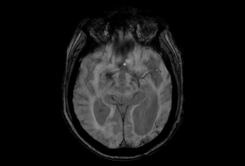 File:Cerebral amyloid angiopathy (Radiopaedia 86671-102792 Axial Gradient Echo 31).jpg