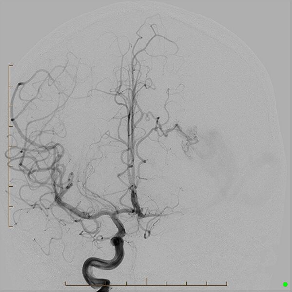 File:Cerebral arteriovenous malformation (AVM) (Radiopaedia 78162-90707 A 9).jpg
