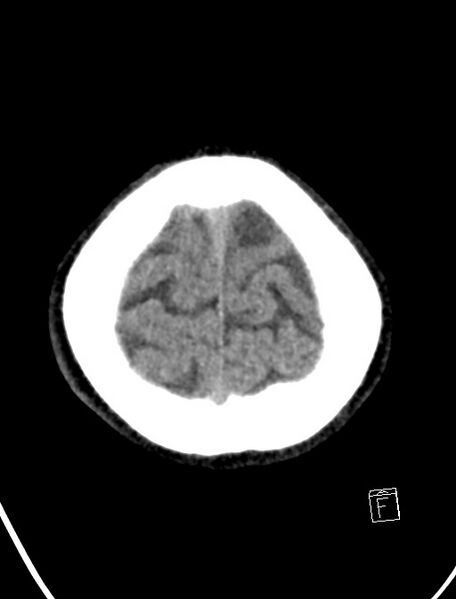 File:Cerebral arteriovenous malformation (Radiopaedia 78188-90745 Axial non-contrast 23).jpg