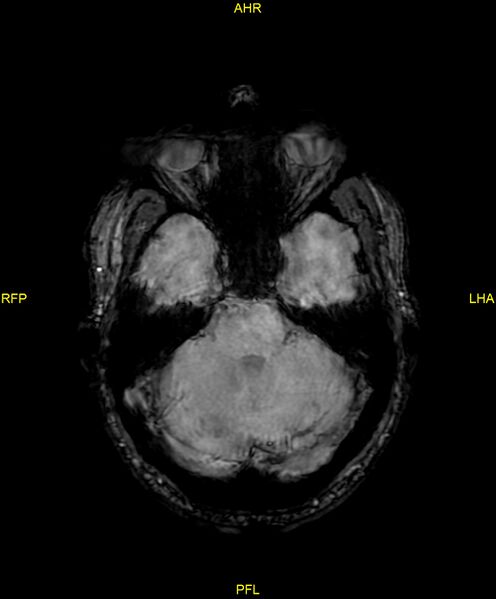 File:Cerebral autosomal dominant arteriopathy with subcortical infarcts and leukoencephalopathy (CADASIL) (Radiopaedia 86108-102054 Axial SWI 34).jpg