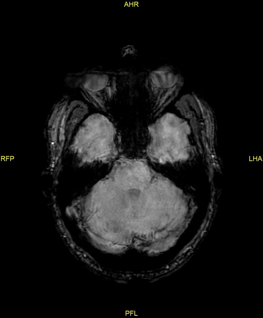 Cerebral autosomal dominant arteriopathy with subcortical infarcts and leukoencephalopathy (CADASIL) (Radiopaedia 86108-102054 Axial SWI 34).jpg