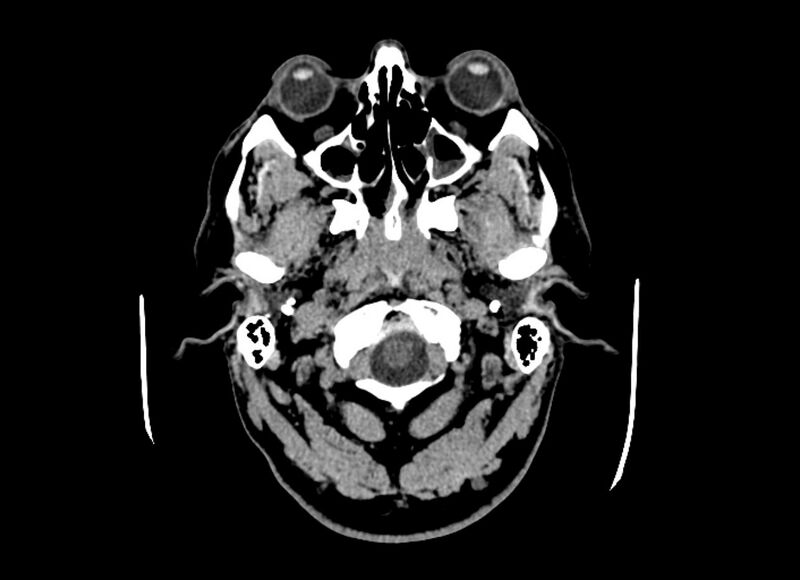 File:Cerebral edema (Radiopaedia 82519-96661 Axial non-contrast 51).jpg