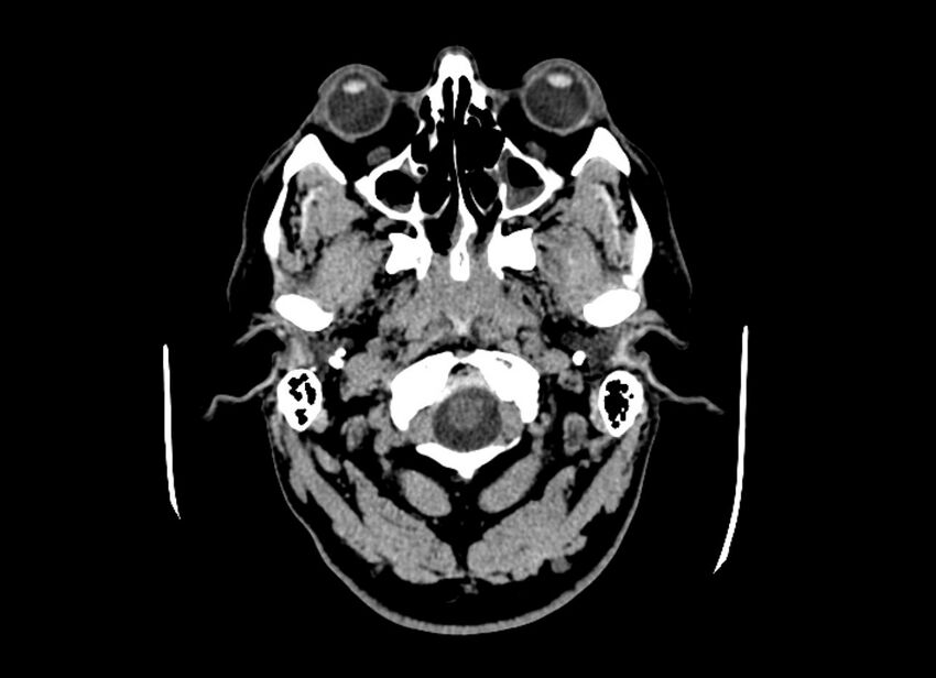 Cerebral edema (Radiopaedia 82519-96661 Axial non-contrast 51).jpg