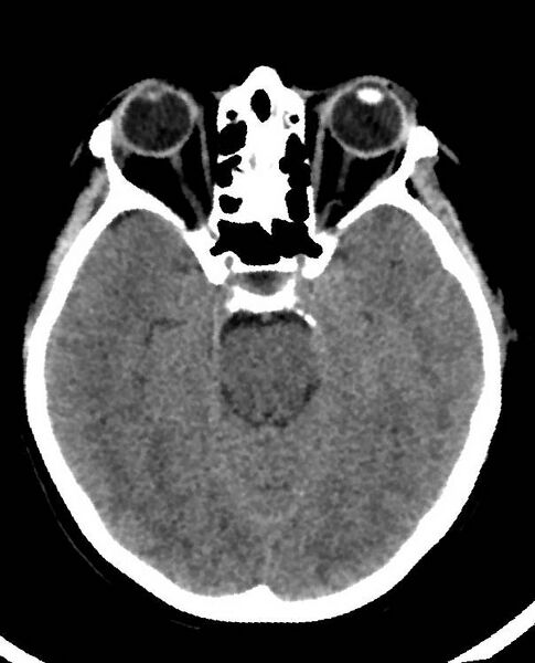 File:Cerebral edema due to severe hyponatremia (Radiopaedia 89826-106938 Axial non-contrast 39).jpg