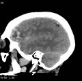 Cerebral hemorrhagic contusion with subdural and subarachnoid hemorrhage (Radiopaedia 10680-11146 C 18).jpg