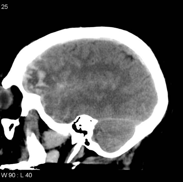 File:Cerebral hemorrhagic contusion with subdural and subarachnoid hemorrhage (Radiopaedia 10680-11146 C 18).jpg