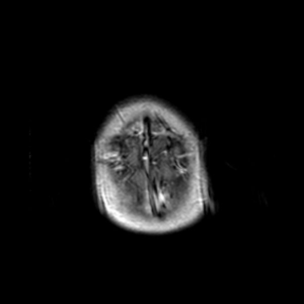 File:Cerebral tuberculoma (Radiopaedia 41152-43932 Axial T1 C+ 22).jpg