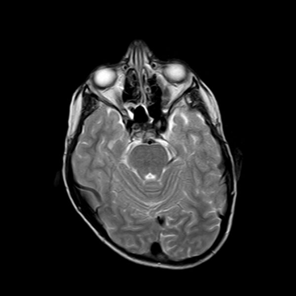 File:Cerebral tuberculoma (Radiopaedia 41152-43932 Axial T2 7).jpg