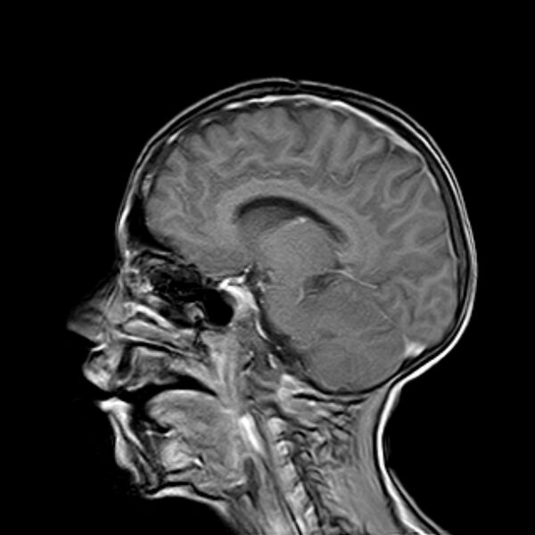 File:Cerebral tuberculoma (Radiopaedia 41152-43932 Sagittal T1 C+ 8).jpg