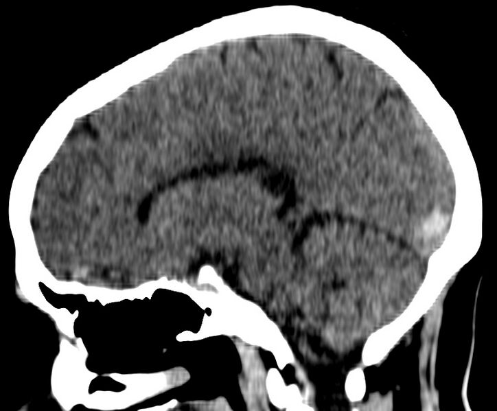 File:Cerebral venous thrombosis - CT only (Radiopaedia 41031-43778 B 21).jpg