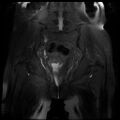 Cervical carcinoma (Radiopaedia 78847-91705 Coronal T2 fat sat 10).jpg