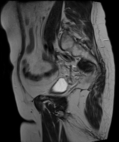 File:Cervical carcinoma (Radiopaedia 88312-104943 Sagittal T2 10).jpg