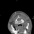 Cervical dural CSF leak on MRI and CT treated by blood patch (Radiopaedia 49748-54996 Axial non-contrast 3).jpg