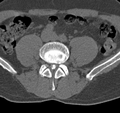 Cervical dural CSF leak on MRI and CT treated by blood patch (Radiopaedia 49748-54996 B 111).png