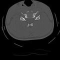 Cervical flexion teardrop fracture with cord hemorrhage (Radiopaedia 32497-33454 Axial bone window 48).jpg
