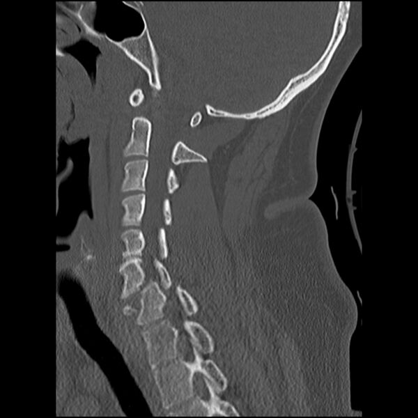 File:Cervical fracture and dislocation with locked facet (Radiopaedia 31837-32780 Sagittal bone window 12).jpg