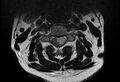 Cervical schwannoma (Radiopaedia 72399-82934 Axial T2 7).jpg