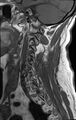 Cervical schwannoma (Radiopaedia 72399-82934 Sagittal T1 2).jpg