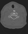 Cervical spine ACDF loosening (Radiopaedia 48998-54071 Axial bone window 37).png
